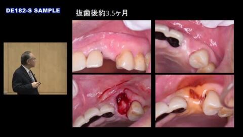 楽天市場】インプラント治療のリッジマネジメントを究める〜抜歯 ...