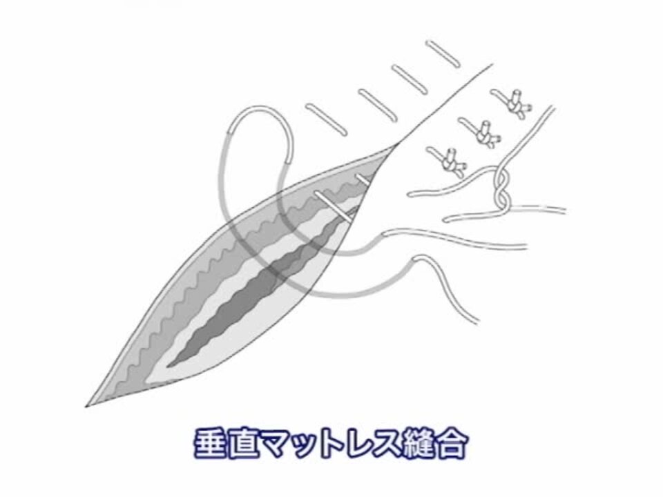 垂直マットレス縫合