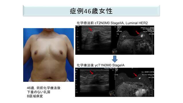 乳房オンコプラスティック・サージャリー2 症例から学ぶ手術手技 乳房オンコプラスティック・サージャリー-症例から学ぶ手術手技