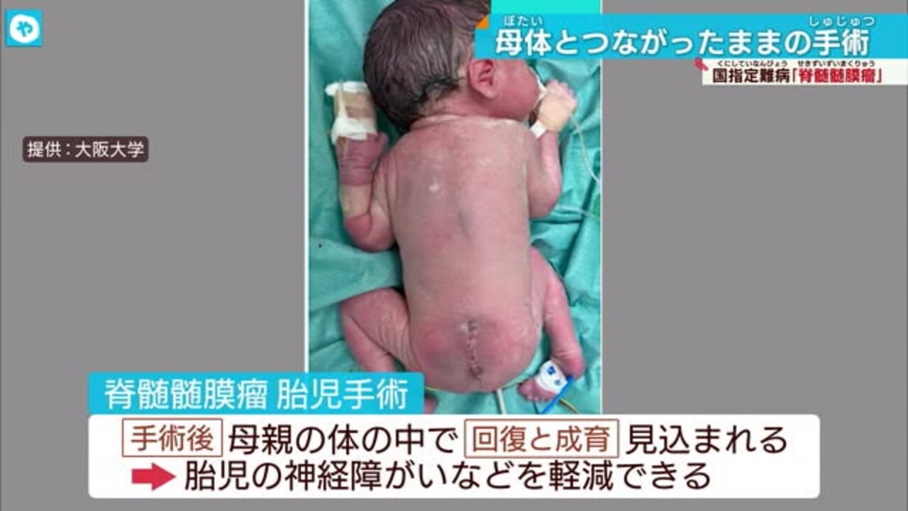 手術　出産 阪大で日本初の手術成功 難病の赤ちゃんを母体とつながった状態で | 大阪NEWS | TVO テレビ大阪