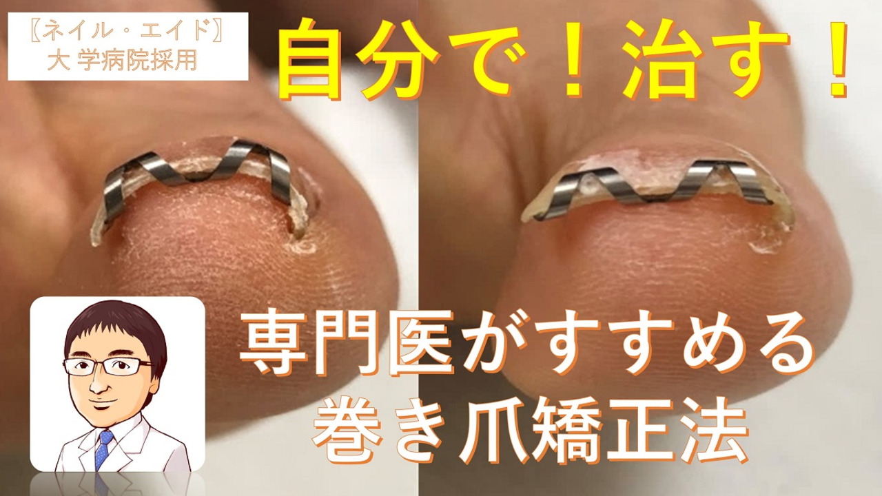 楽天市場】【追加購入専用 18mm】巻き爪 治療 自分で 矯正 【 ネイル